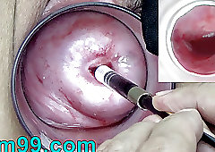 Scuttlebutt recomended playing endoscope hole insertion woman urethral