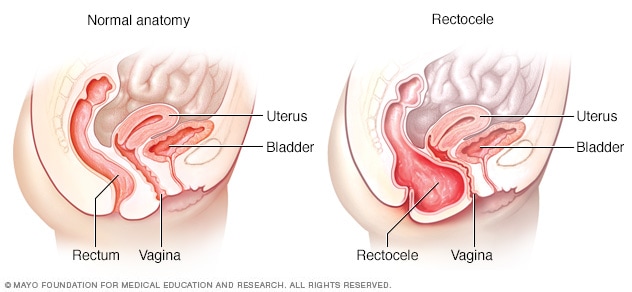 Hard-Boiled recomended into Cytocele vagina protruding bladder