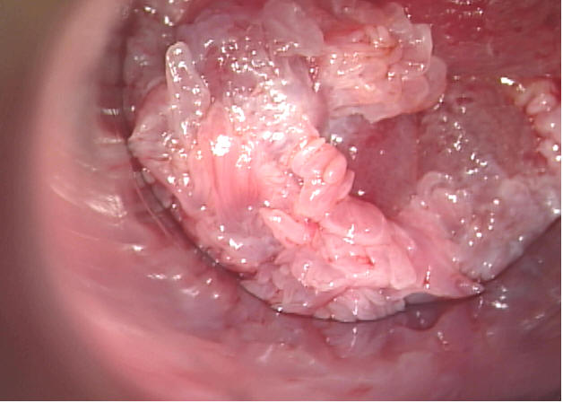 best of Warts inside anus Genital