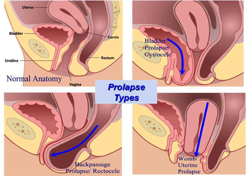 Cytocele bladder protruding into vagina