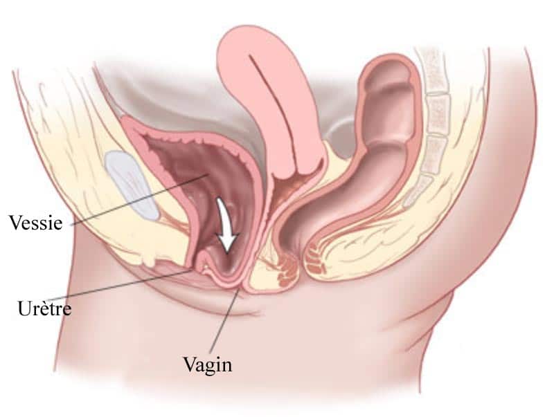 best of Vagina into Cytocele protruding bladder