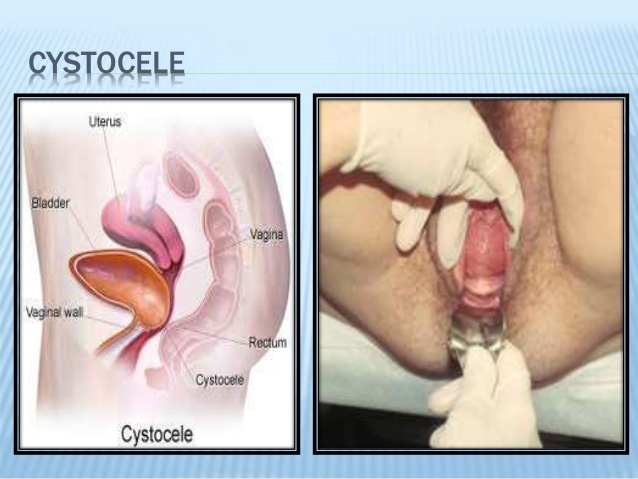 Cytocele bladder protruding into vagina