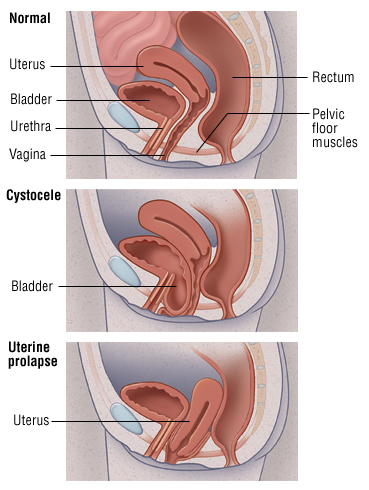 Black I. reccomend Cytocele bladder protruding into vagina