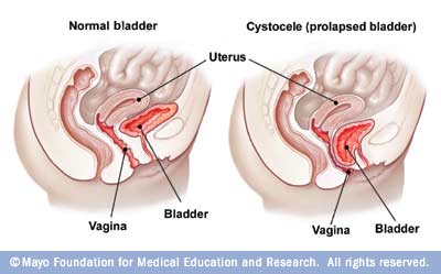 Storm reccomend Cytocele bladder protruding into vagina
