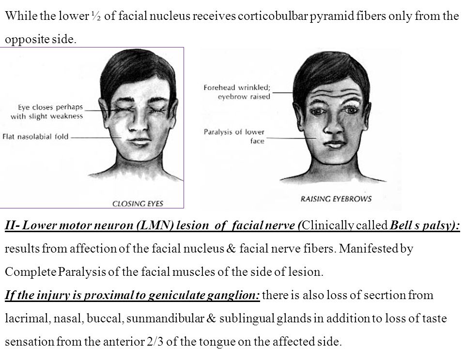 Unilateral facial palsy