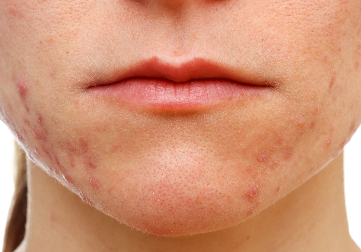 best of Oral for Best acne antibiotic