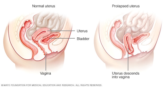 Fumble reccomend into Cytocele vagina protruding bladder