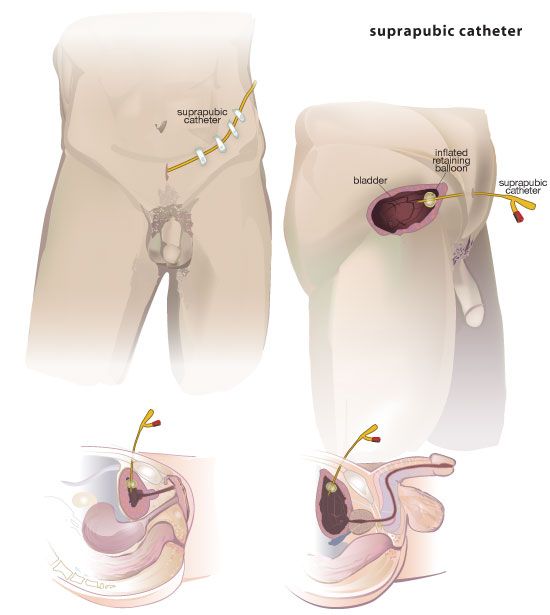 best of Urinary fetish Male catheterisation