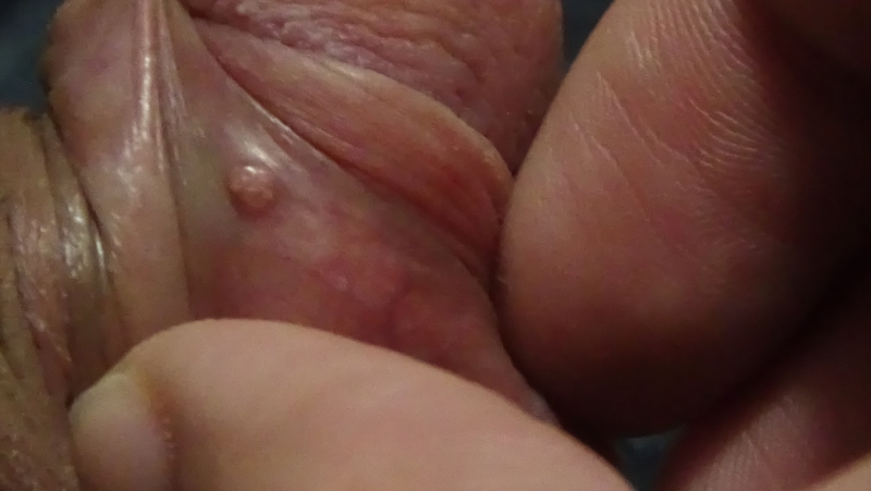 Sparkles reccomend Std white blisters in clitoris