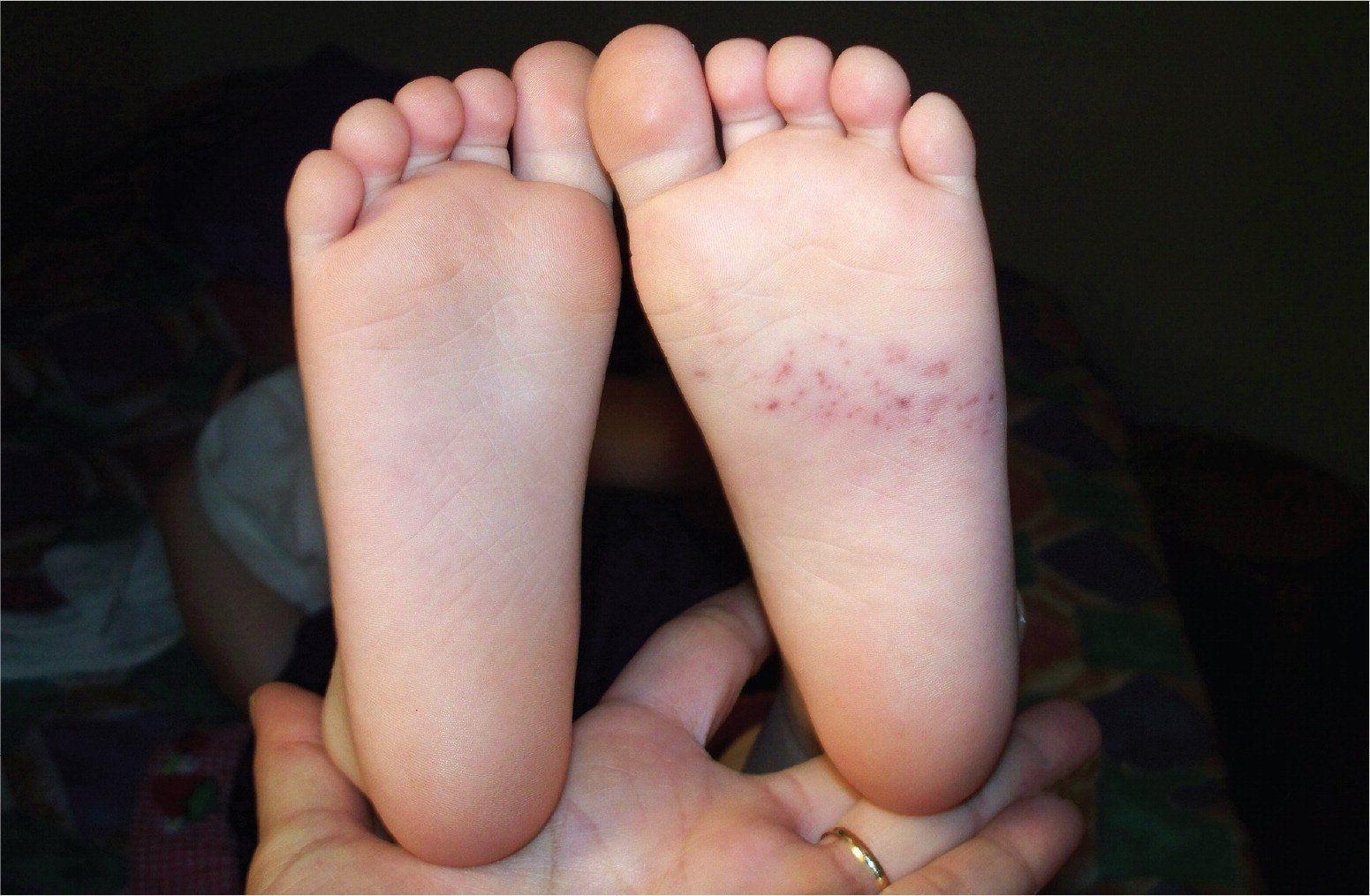 Crusher reccomend Itchy rash on bottom of foot