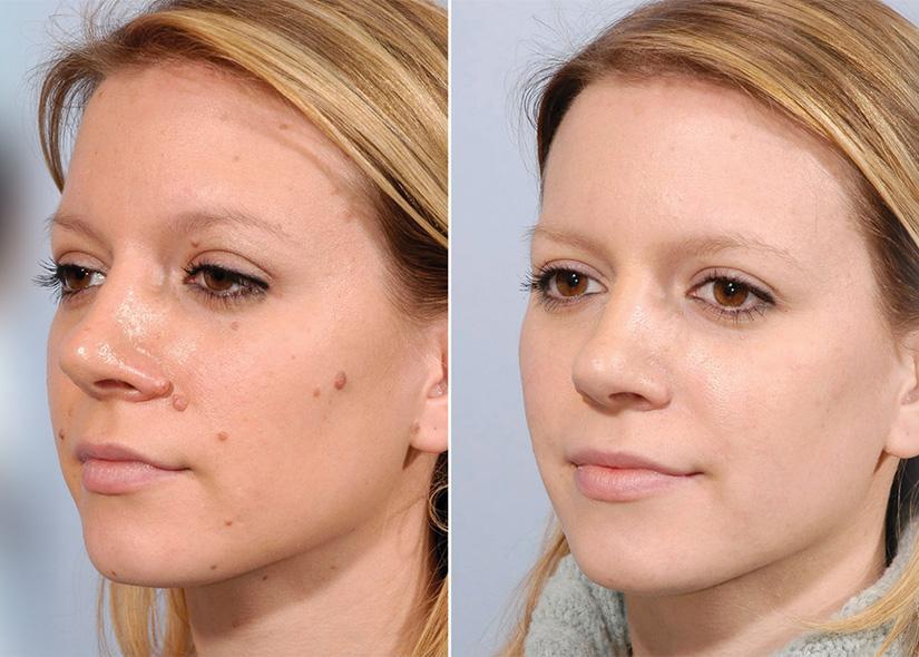 Facial mole removal procedure