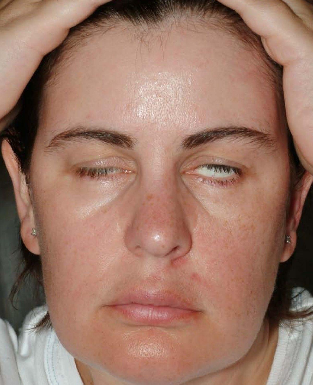 best of Ticks sarcoidosis Facial