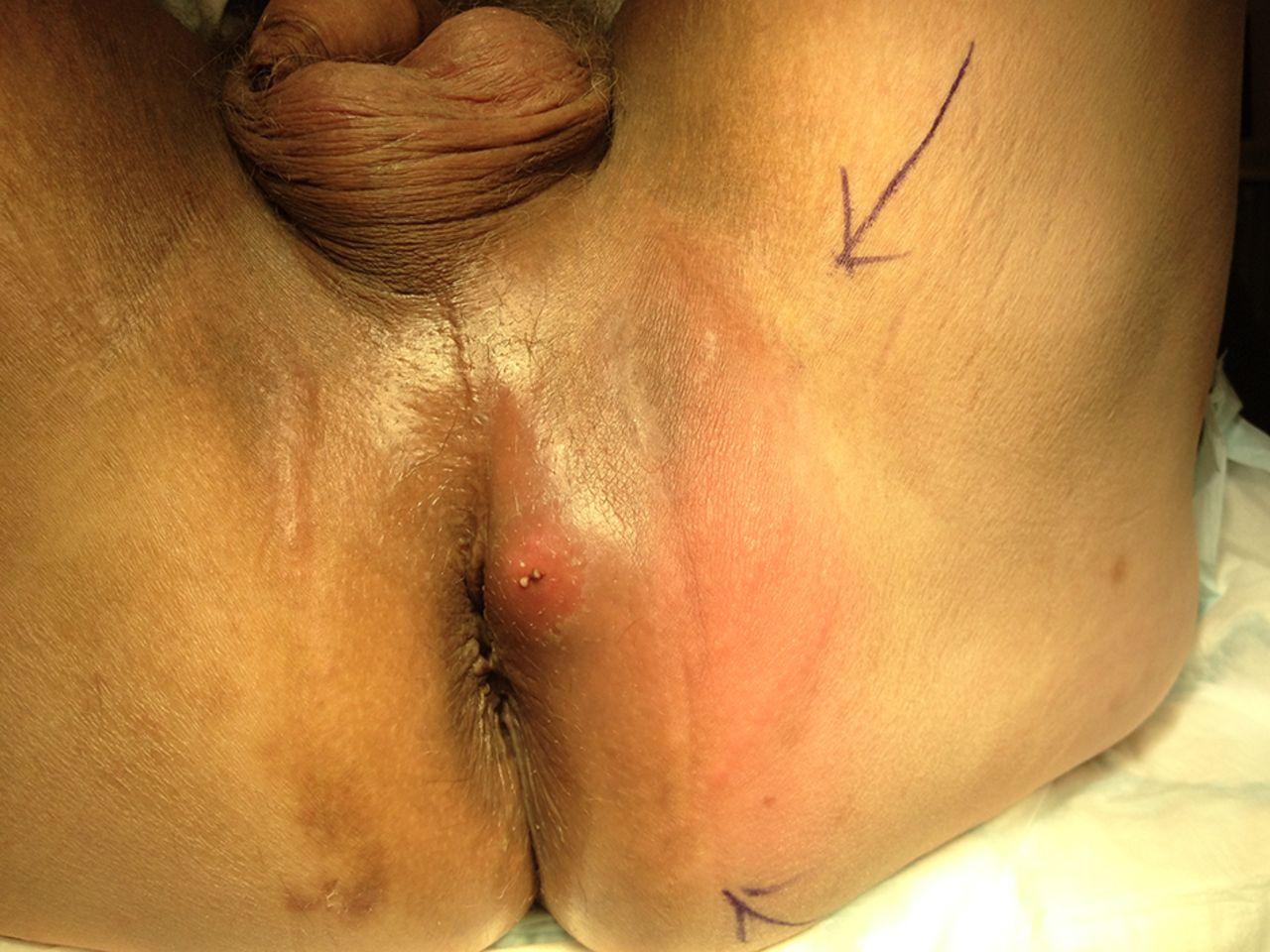 Captain H. recommend best of fistula Nhs abcess anal