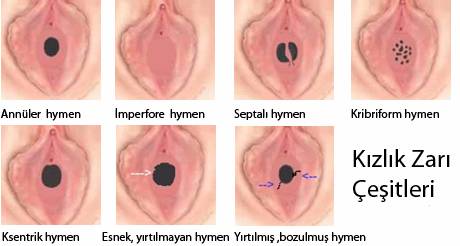 Virgin hymen holes