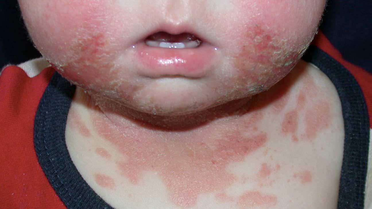 best of Mouth Facial rash
