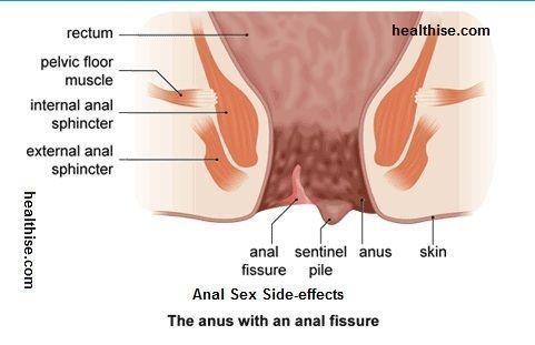 Red F. reccomend Anal sphincter sex
