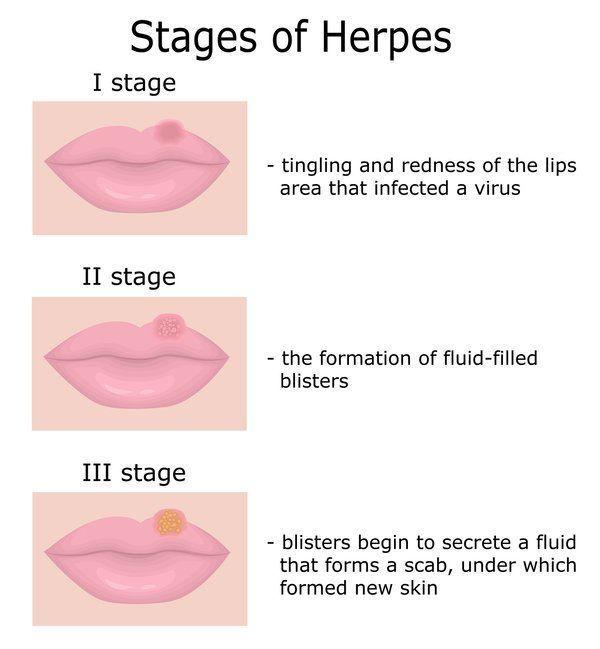 Herpes mutual masturbation