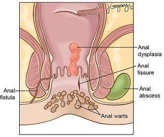 Lump on left side of anus