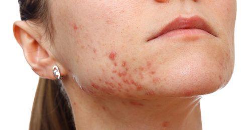 best of Facial permantly Diminish spots