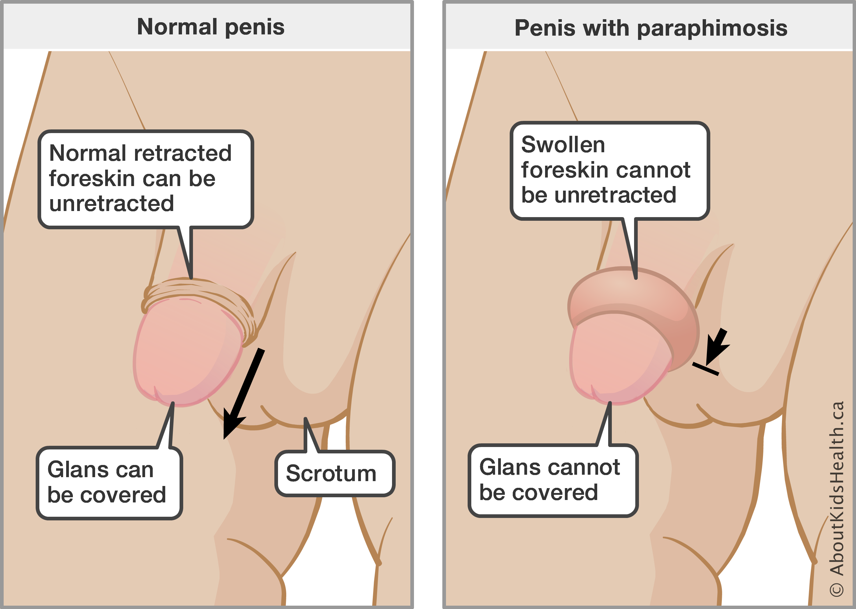 Treating sore penis after sex