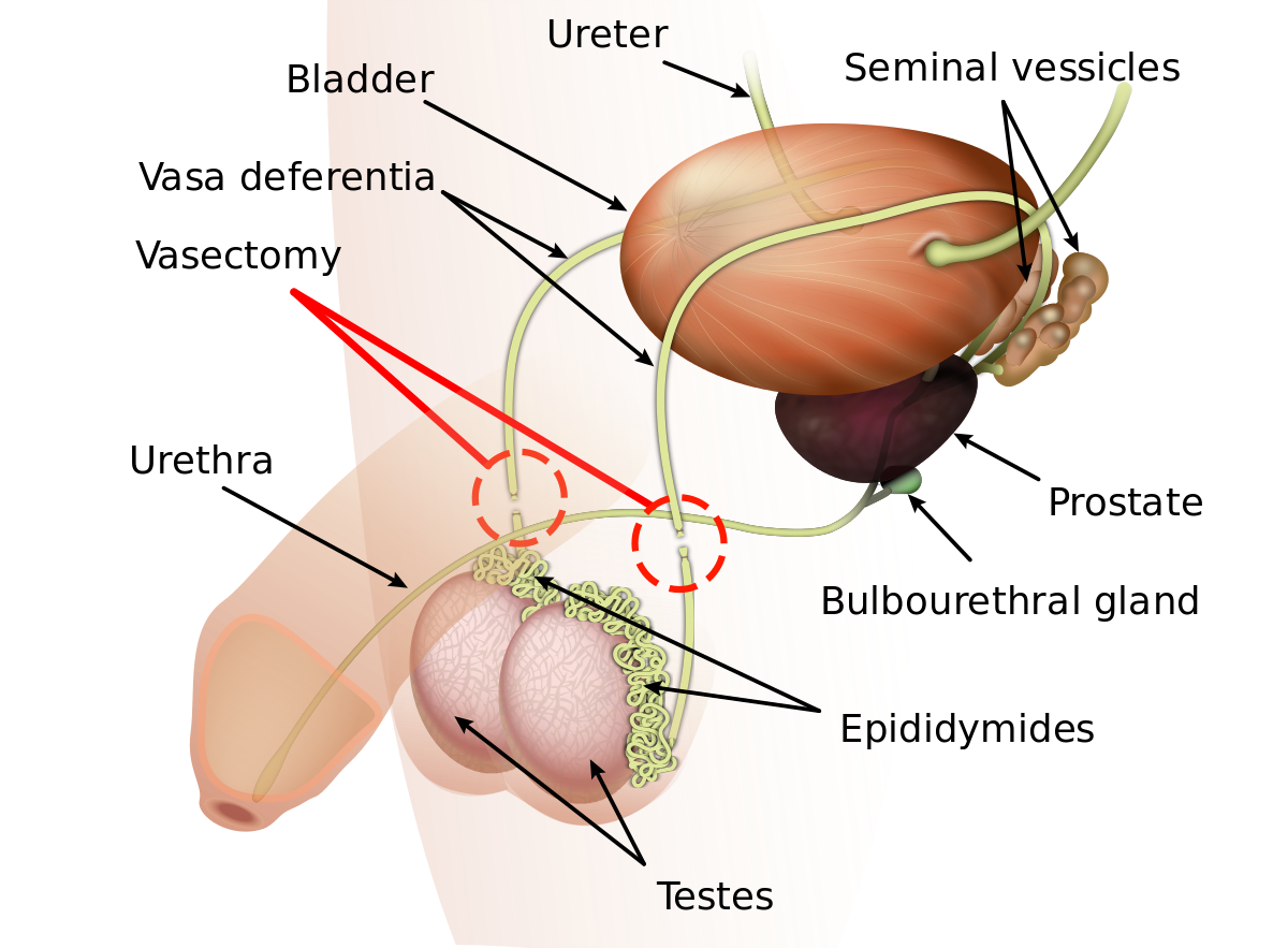 Bullseye recommendet function reversal in sperm of of Impact vasectomy