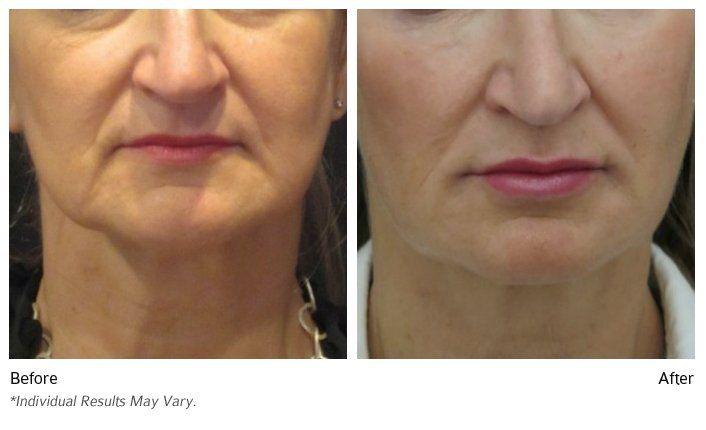 best of Facial New fillers canaan