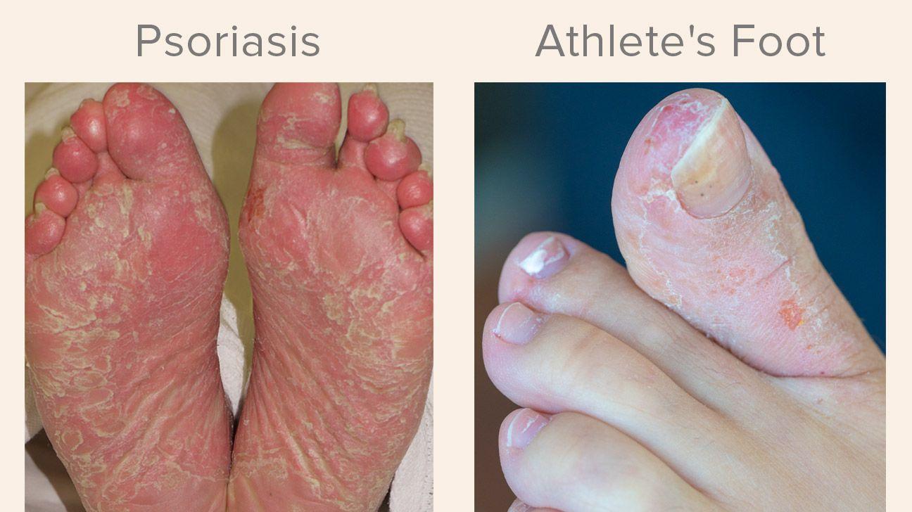Peeling skin from bottom of foot