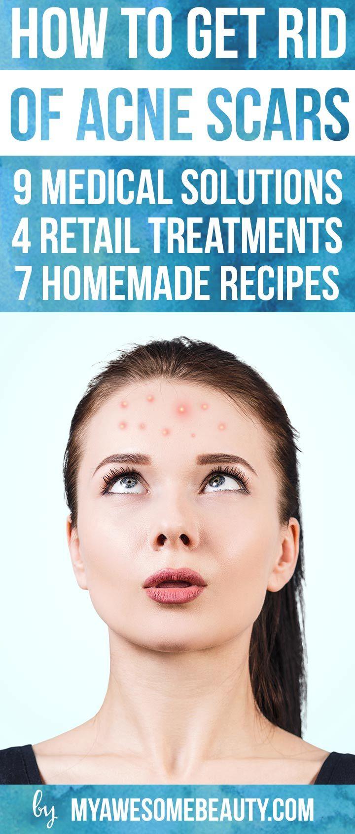 How to get rid of acne effectively