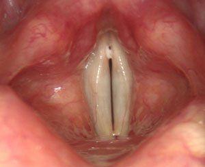 Jessica R. reccomend Lump in throat gerd
