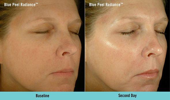 best of Facial peel Gycolic