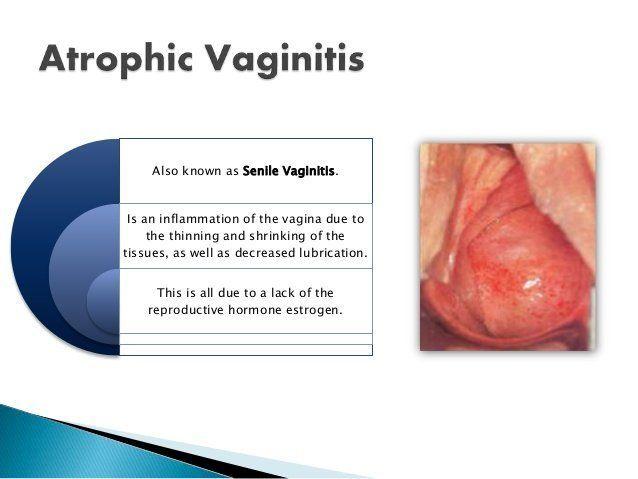 Diseases of vagina