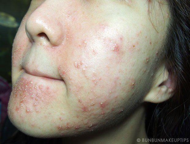 Facial skin allergies