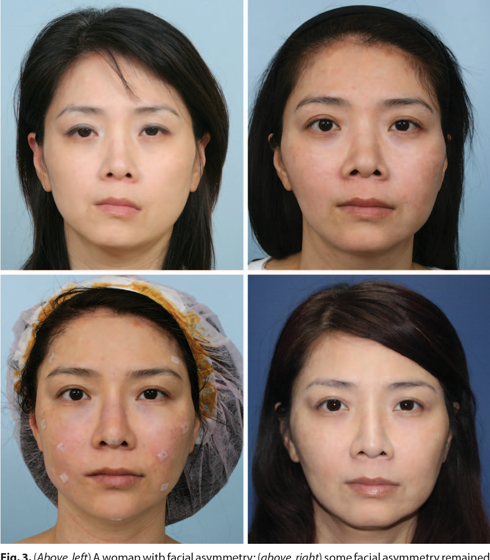 best of Assymetry And facial