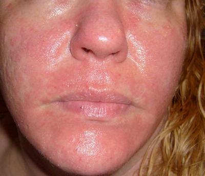 best of Allergies Facial skin