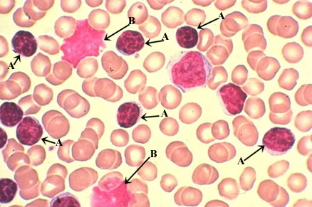 best of Lymphocytes smudge cells Mature