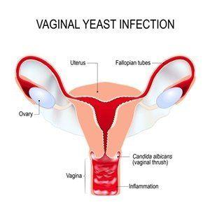 best of And dryness Vaginal yeast infection