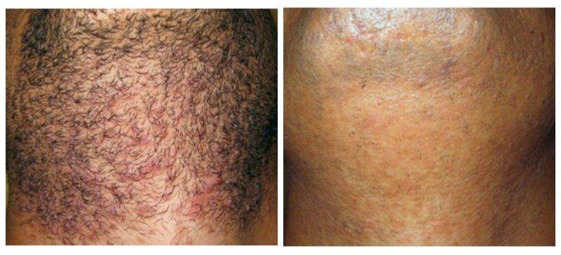 best of Facial removal for hair hair Laser