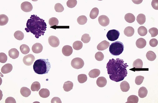 Snicky S. reccomend lymphocytes cells Mature smudge