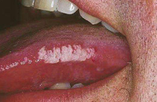 Jupiter reccomend leukoplakia What Hairy hairy causes