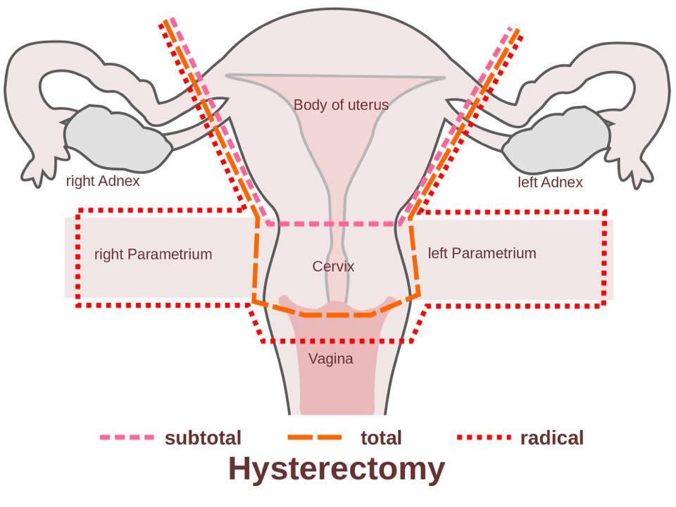 best of Effects of side hysterectomy anuss Possible