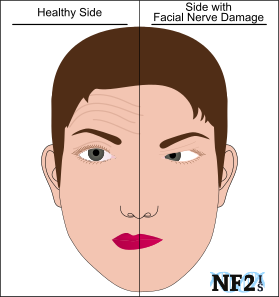 best of Medication Facial paralysis