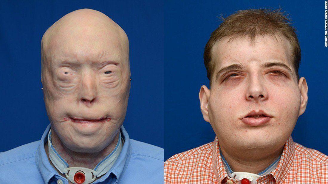Extensive facial plastic surgery pictures