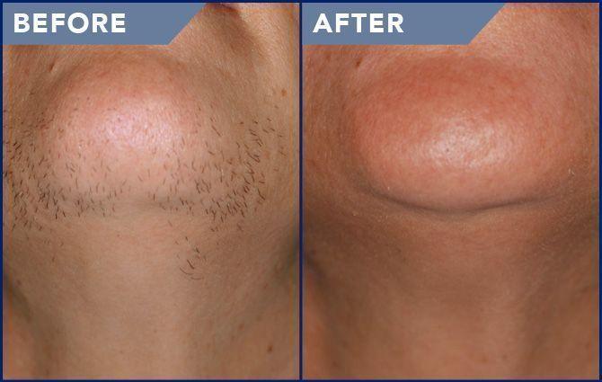best of Facial removal for hair hair Laser