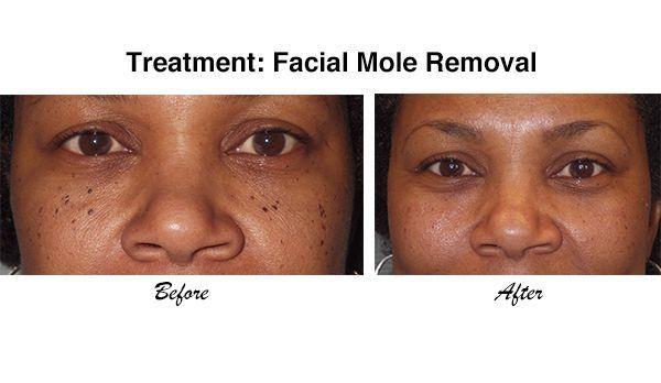Facial skin moles