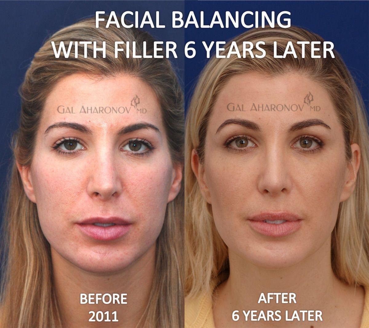 Facial fillers and pictures
