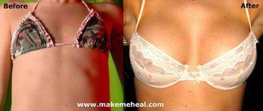 Moth reccomend Teenage girls with a breast augmentation
