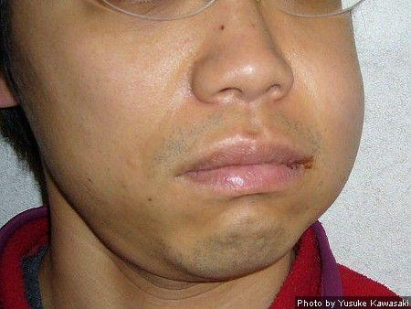 Facial swelling extraction