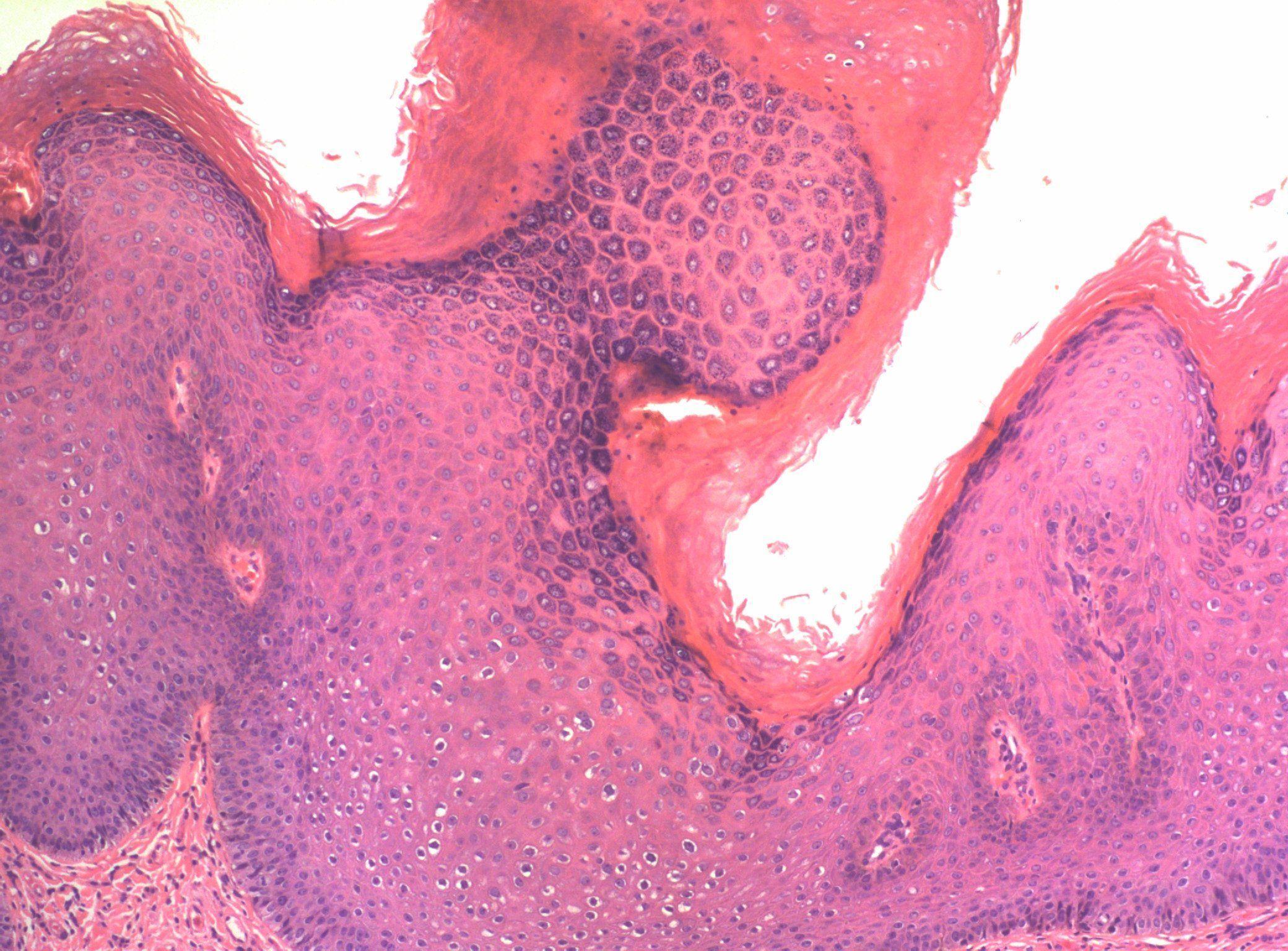 best of Dysplasia vulva Papillomata