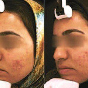 Facial acne vulgans dermabrasion treatment