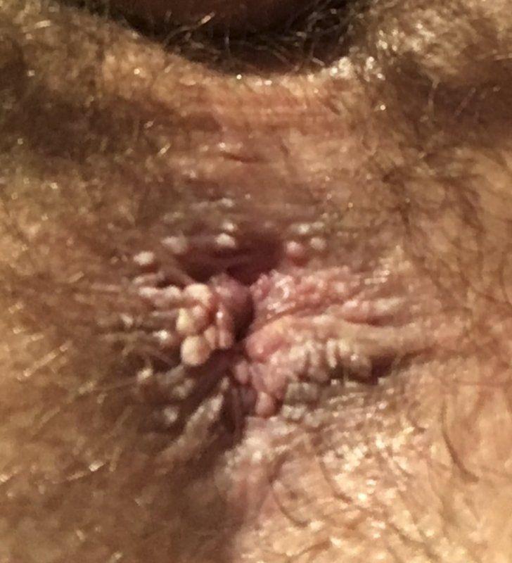 Small bumps on anus